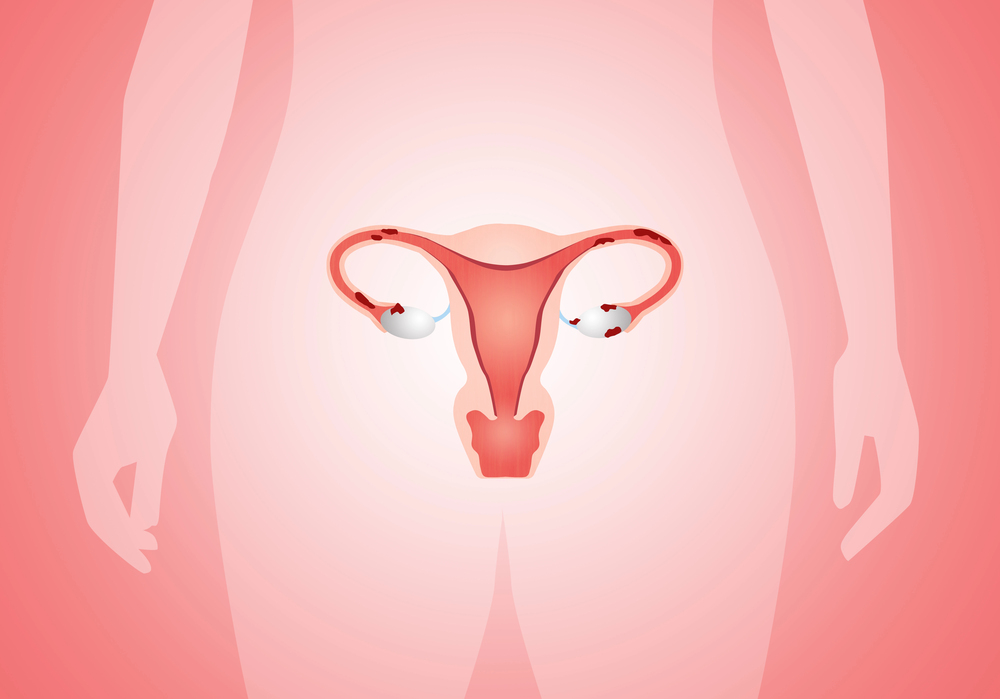 Principais tratamentos para engravidar com endometriose 1 tratamentos para engravidar com endometriose